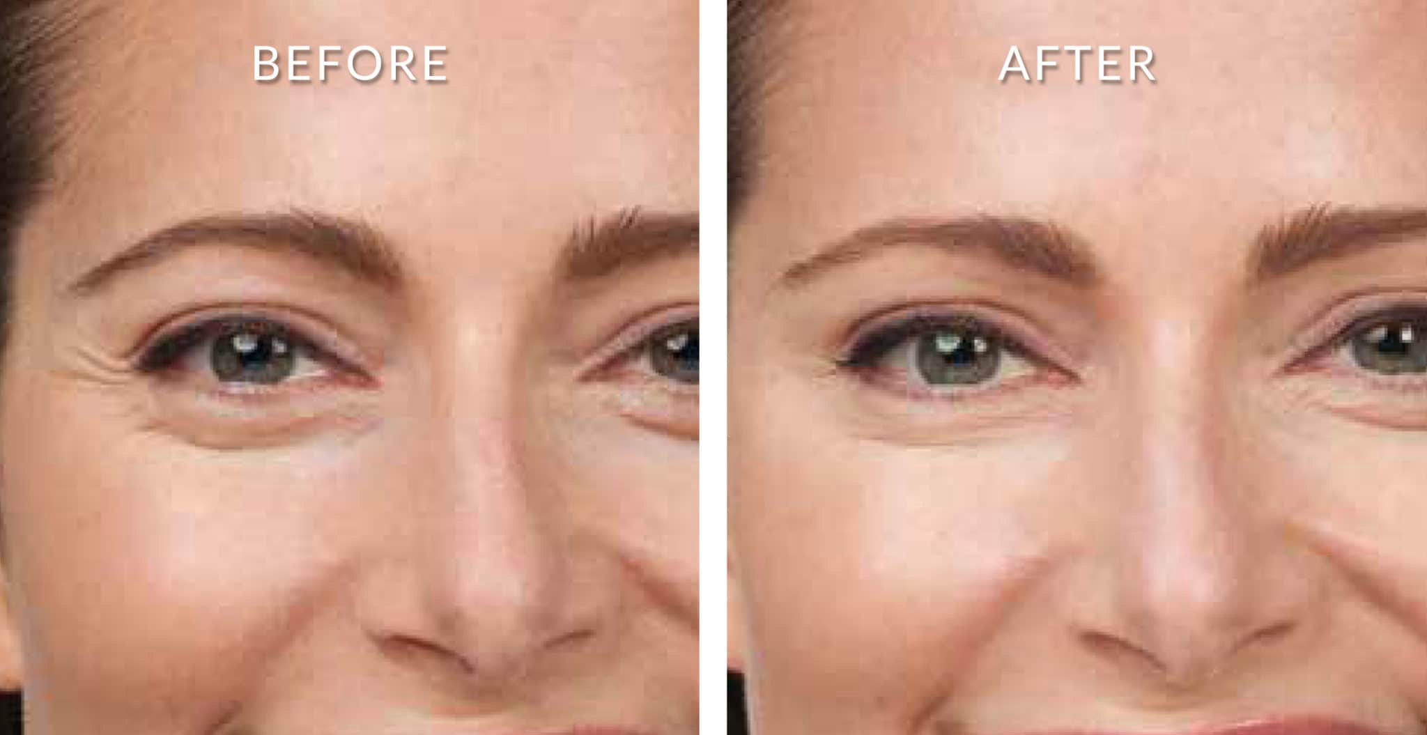 Botox After Before
