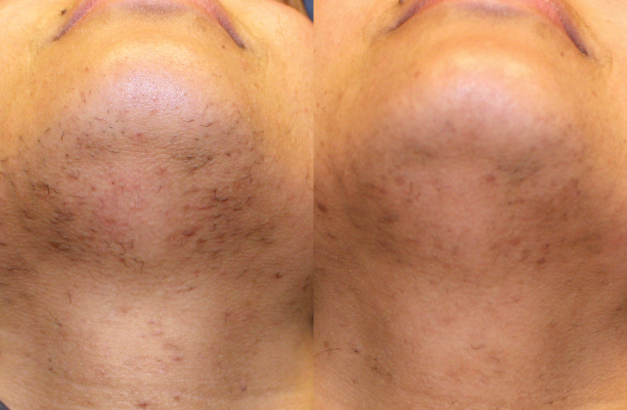 Laser Hair Removal Before After