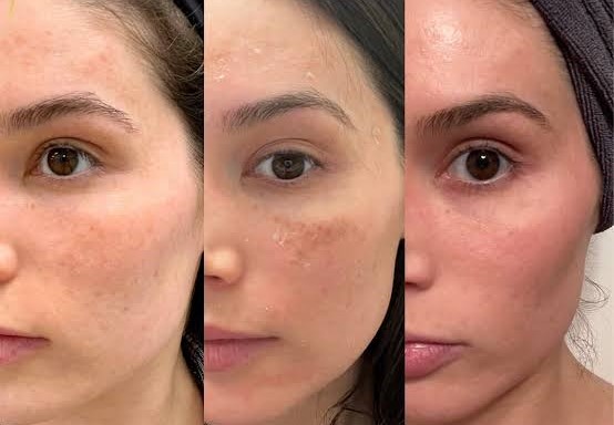 Carboxy Peel