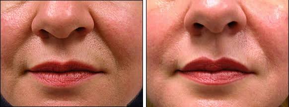 Collagen Filler