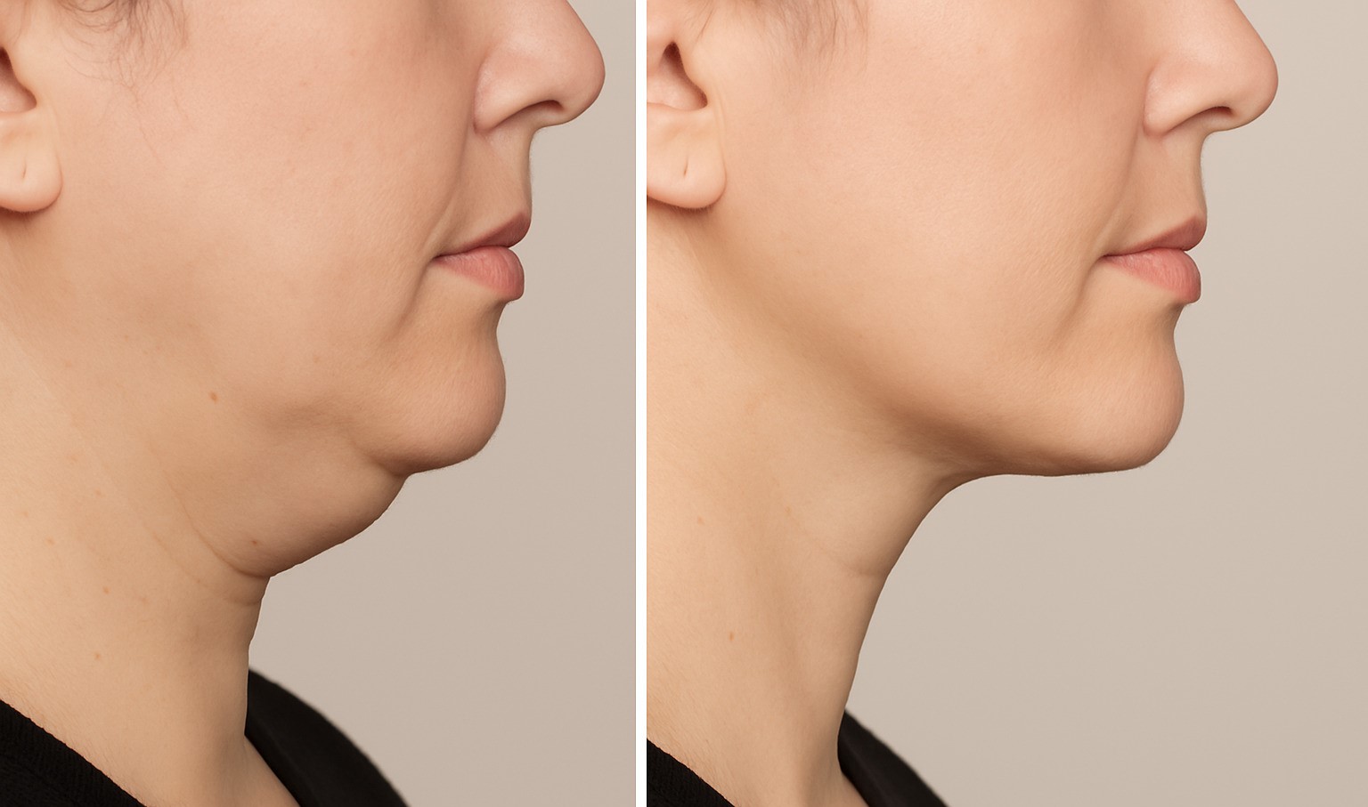 Cryolipolysis