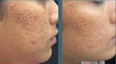Fractional Laser Treatment