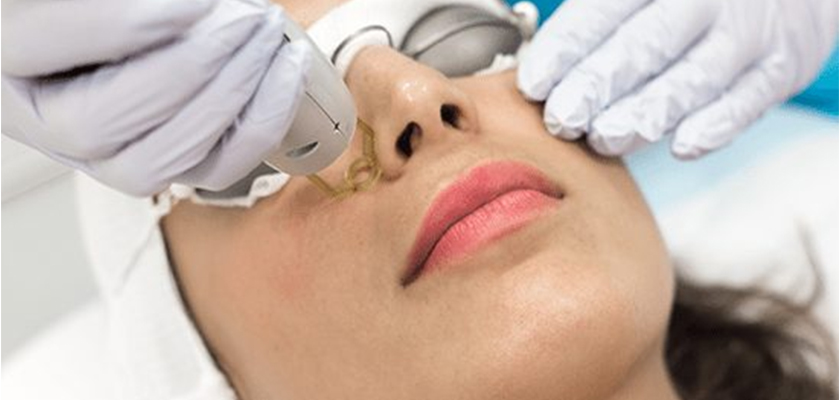 Gentle Pro YAG Laser