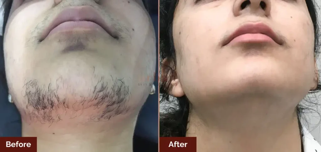 Laser Hair Removal