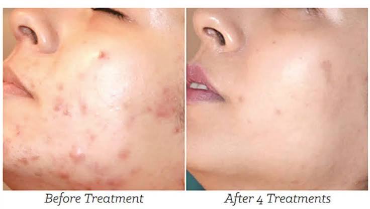 Mesotherapy After Before 2