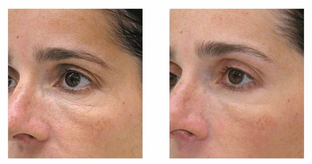 Mesotherapy After Before
