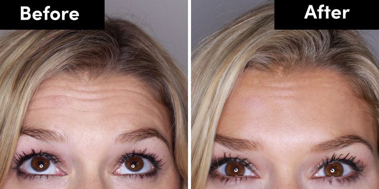 Botox After Before 2