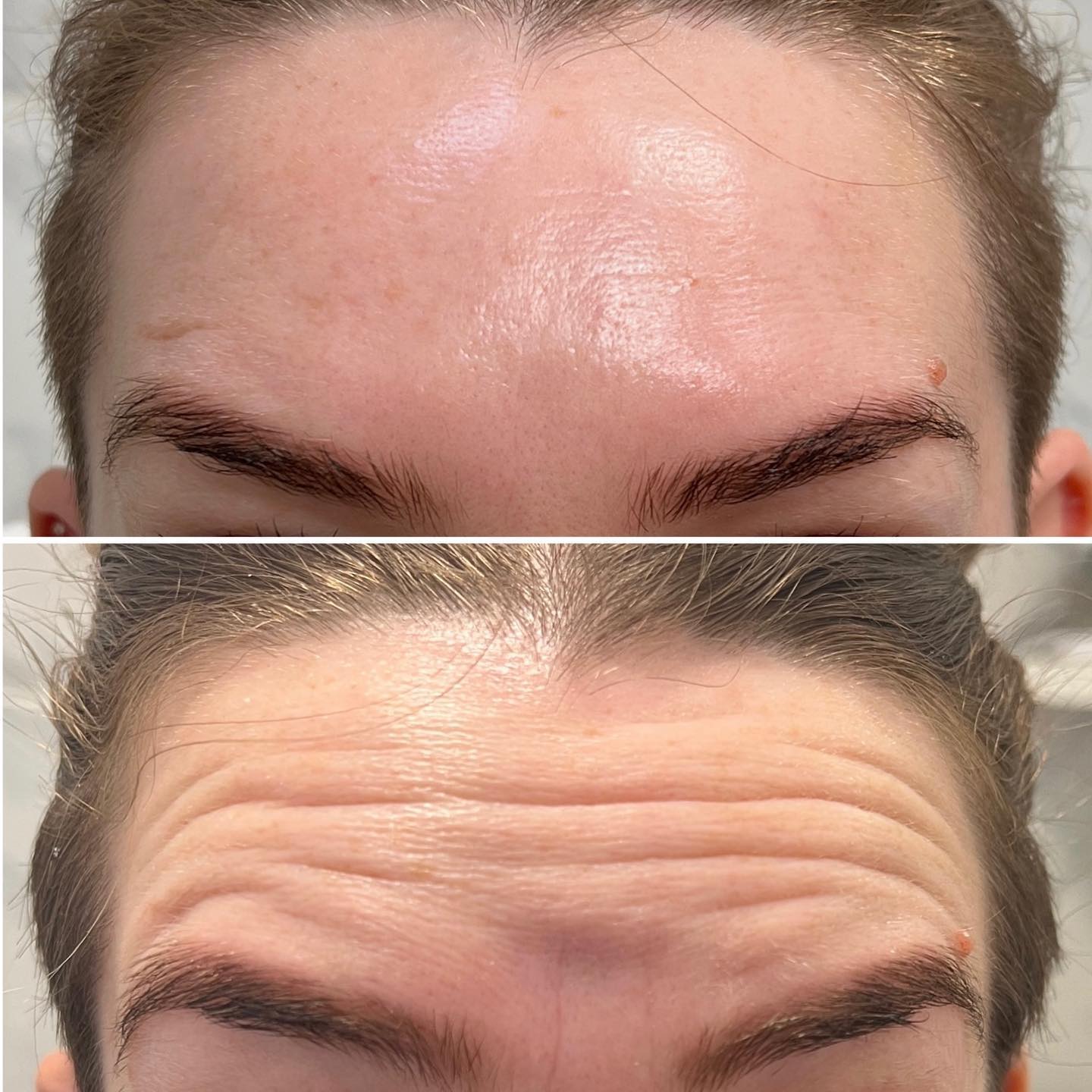 Botox