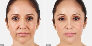 Filler After Before