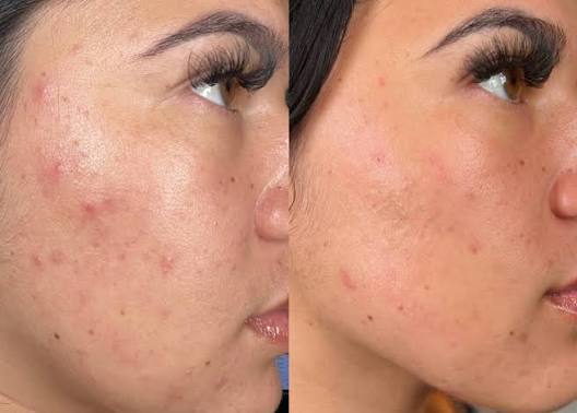 Hydra Facial