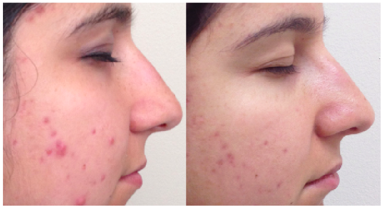 Skin Resurfacing