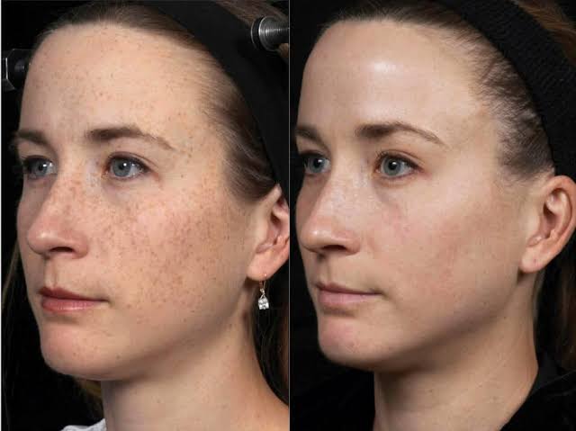 Skin Rejuvenation
